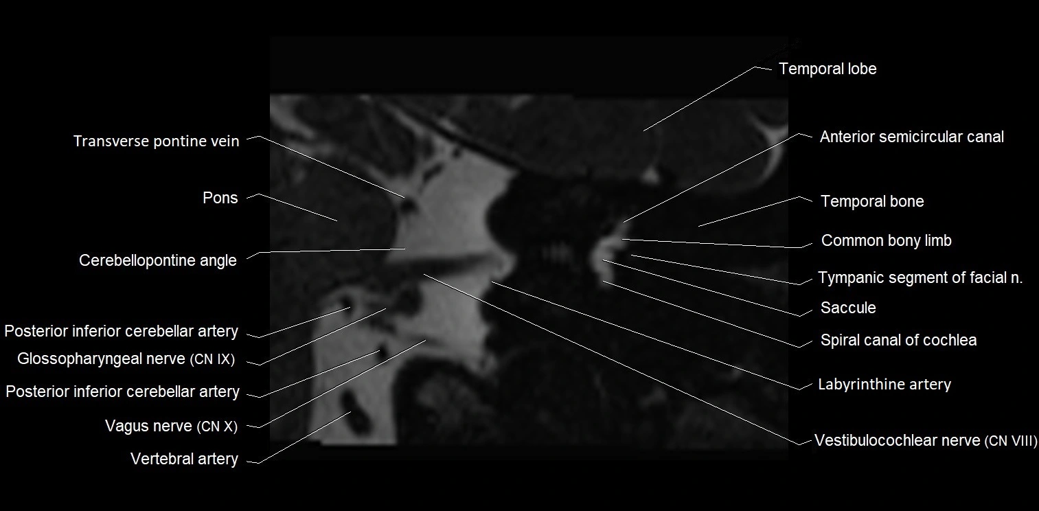 MRI Internal auditory meatus (IAM) coronal cross sectional labelled anatomy image 16.webp